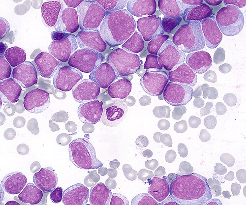 acute myeloid leukemia